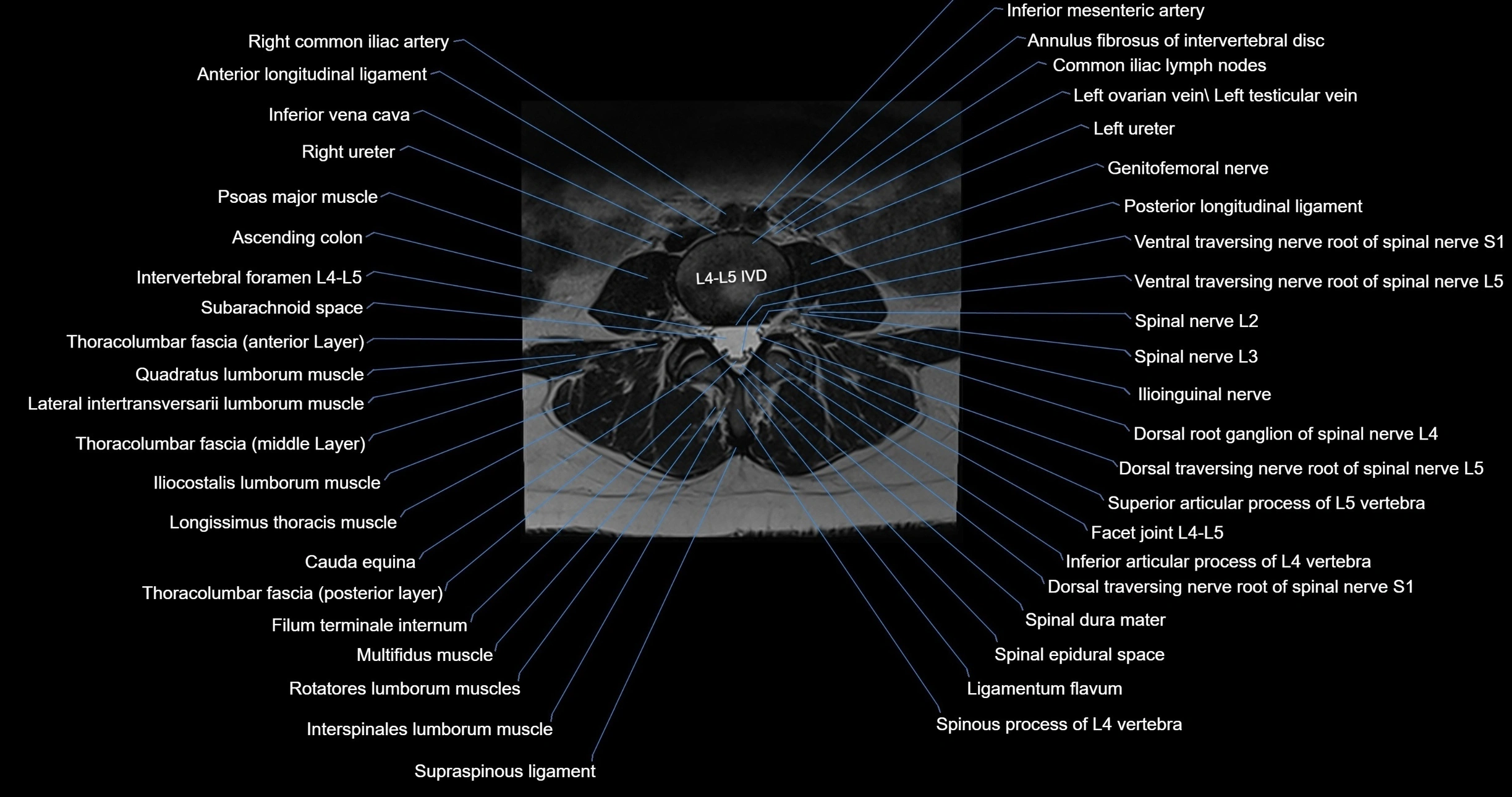 MRI lumbar spine axial cross sectional anatomy 3T radiology  image-img-00001-00033.webp
